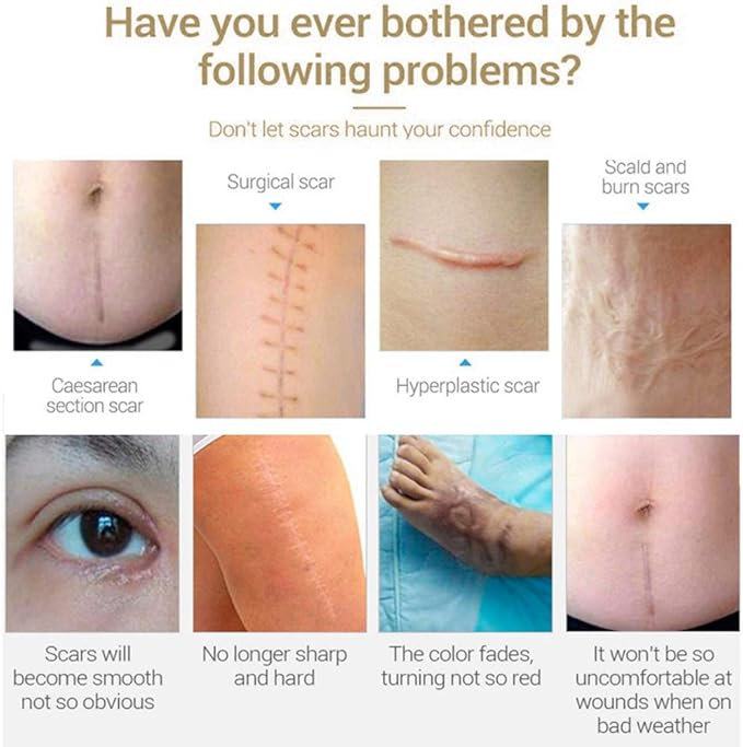 Scar & Acne Mark Removal - पुराना दागहरू हटाउने प्रभावकारी समाधान!