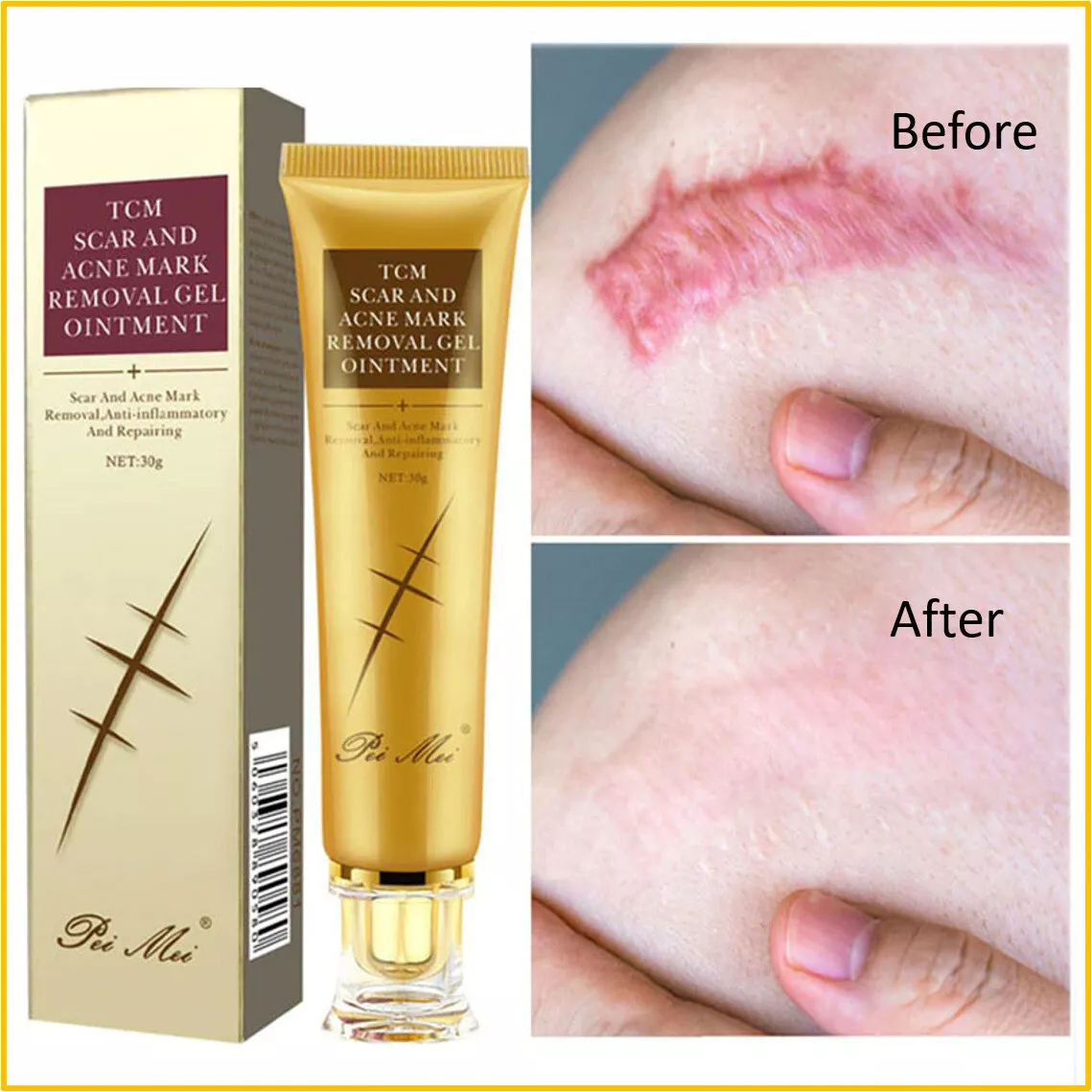 Scar & Acne Mark Removal - पुराना दागहरू हटाउने प्रभावकारी समाधान!